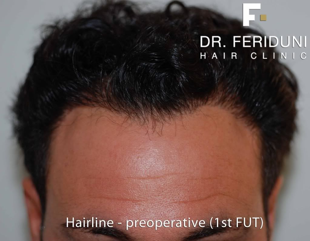 Lhuile pour les cheveux de la moutarde